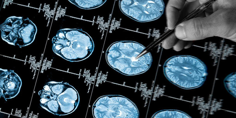 irm et alzheimer
