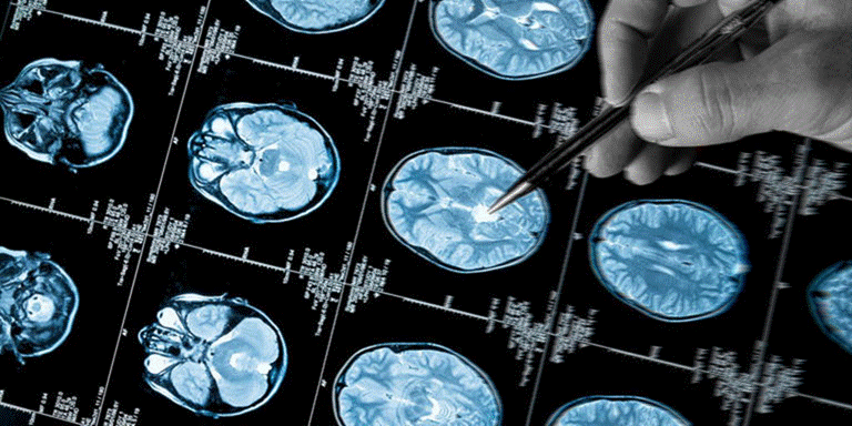irm et alzheimer
